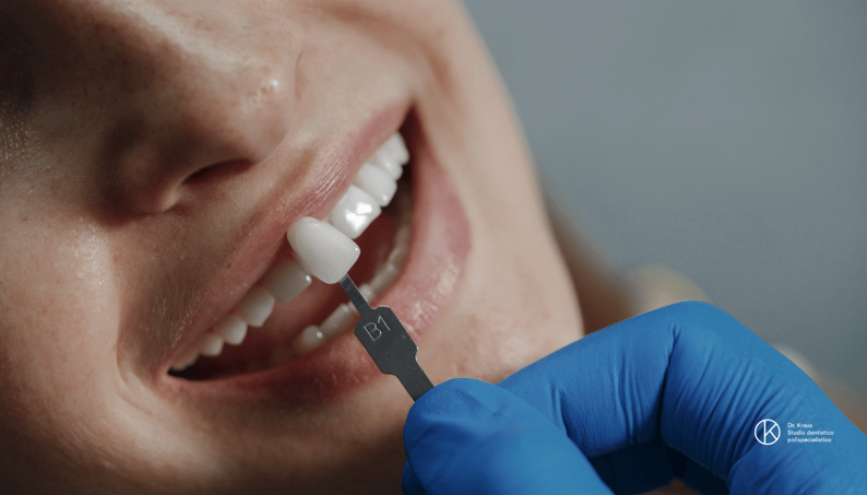 Le faccette dentali