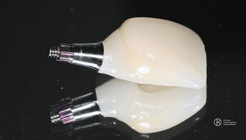 Implantologia dentale Lugano