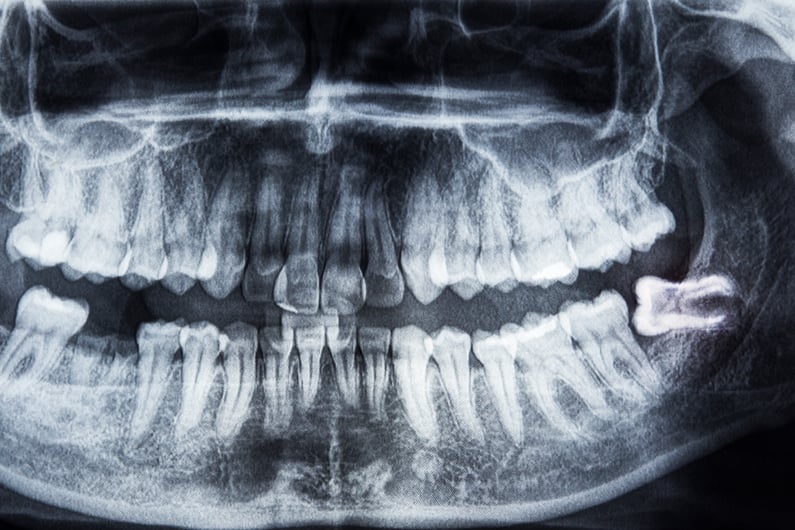 curiosità denti del giudizio