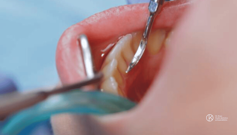 levigatura denti