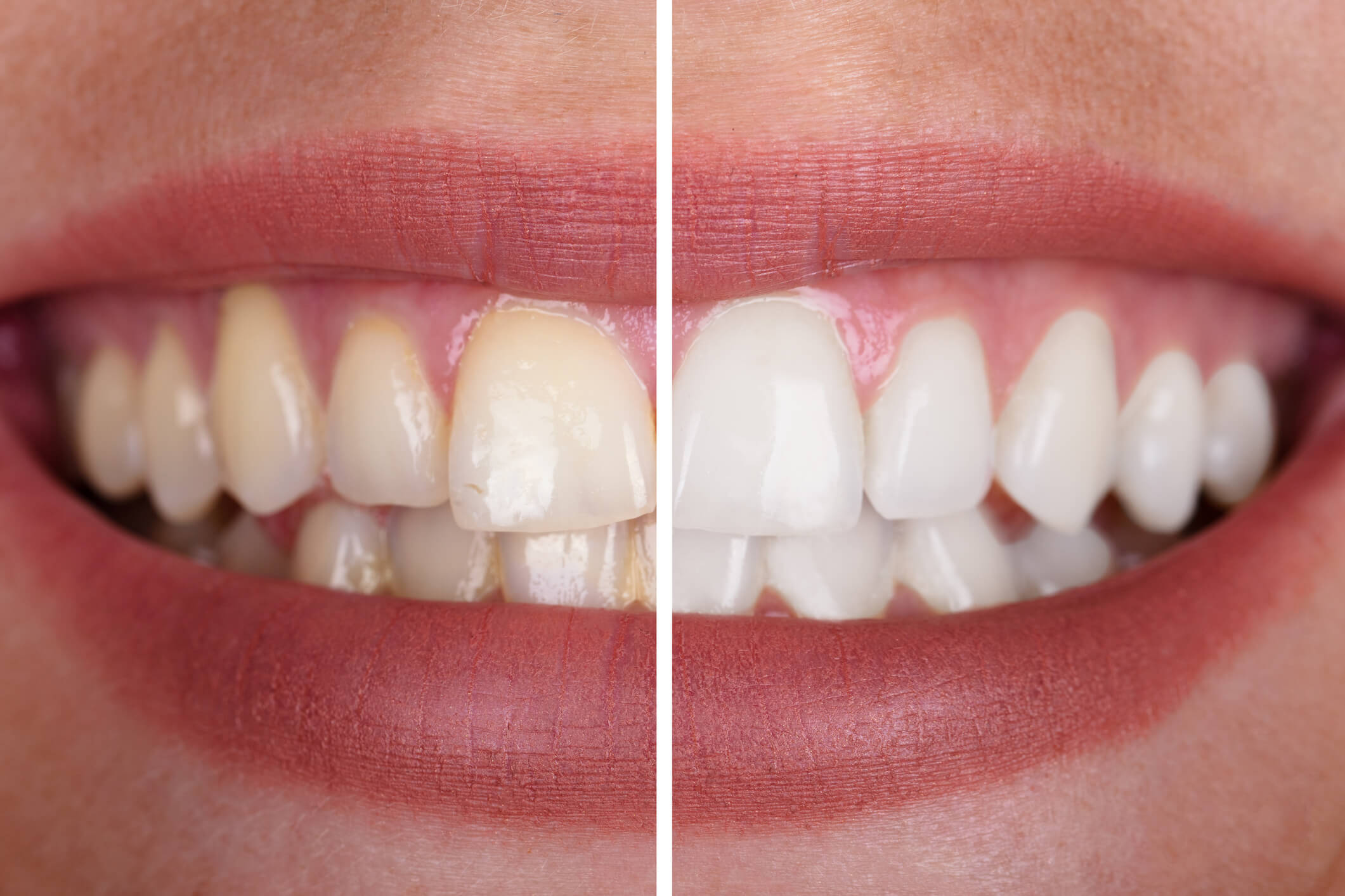 Sbiancamento denti o bleaching_articolo