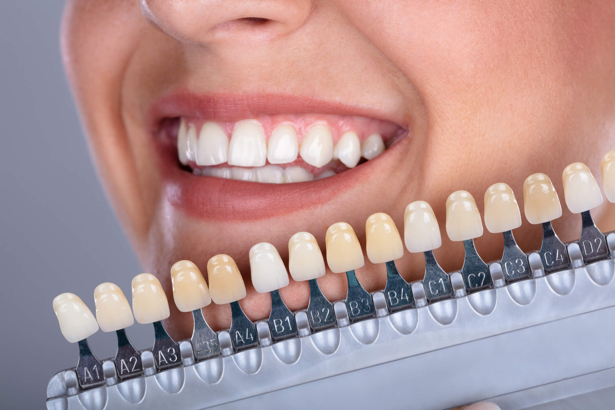 Veneers faccette dentali