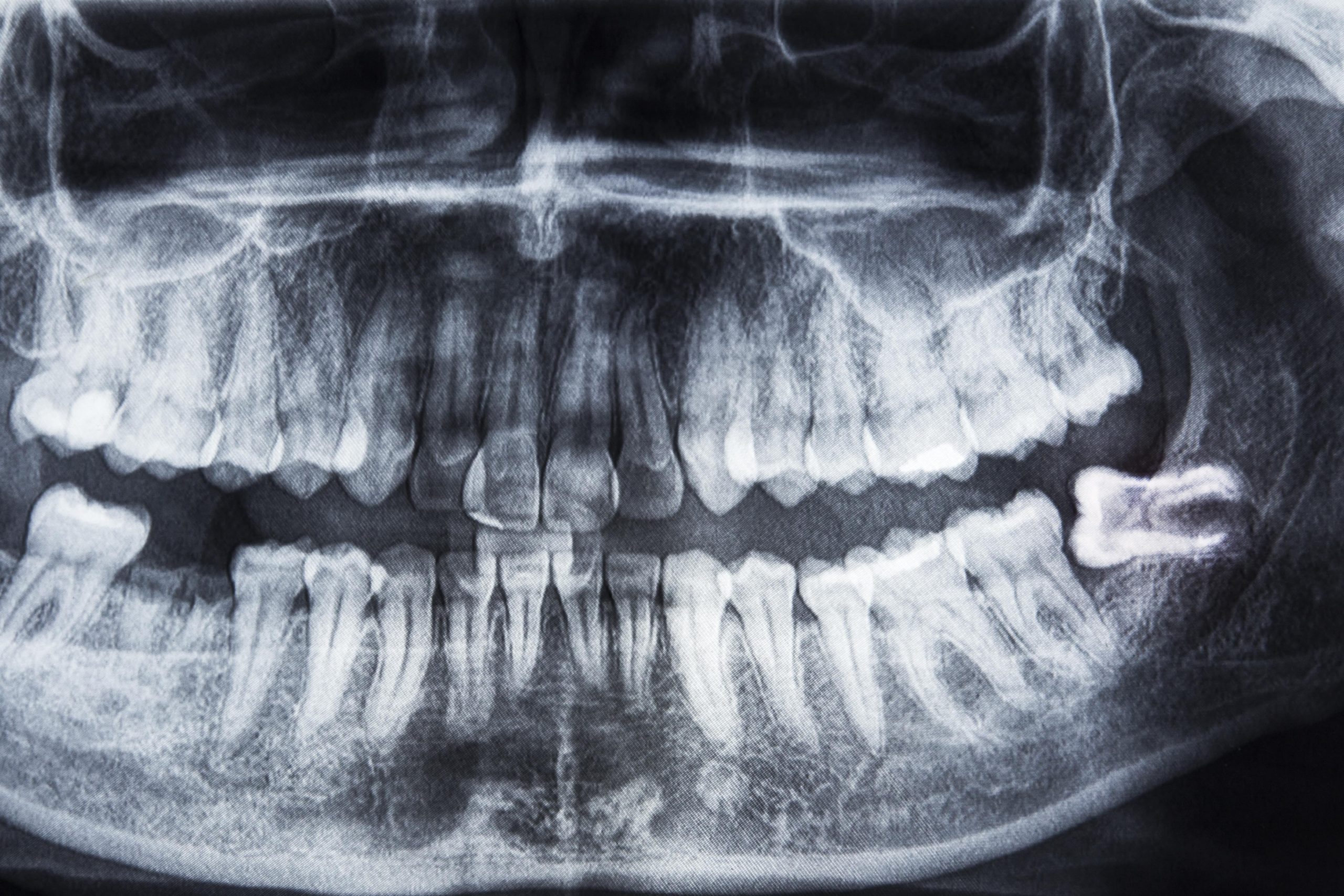 curiosità denti del giudizio_articolo
