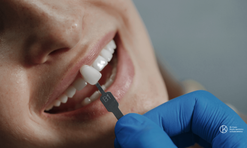 Faccette dentali tutto quello che_articolo