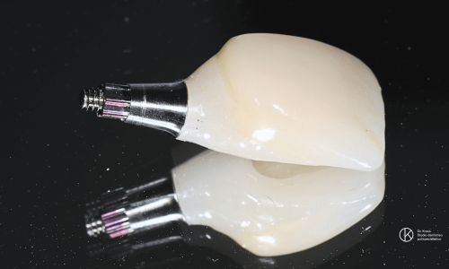Implantologia dentale Lugano