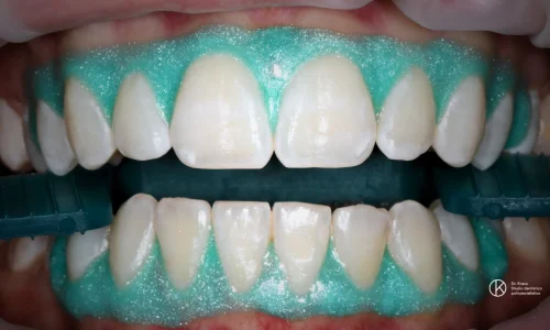 Sbiancamento denti Lugano