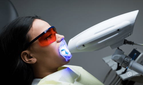 Sbiancamento denti con il laser
