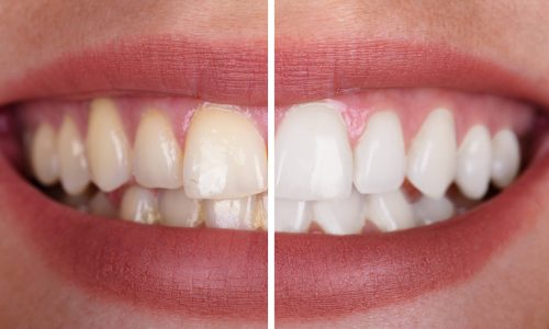 Sbiancamento denti o bleaching_articolo