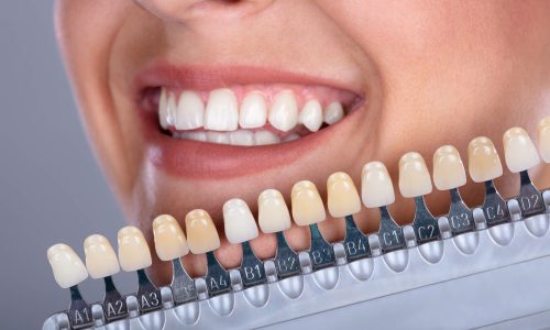 Veneers faccette dentali